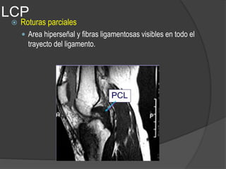 LCP
 Roturas parciales
 Area hiperseñal y fibras ligamentosas visibles en todo el
trayecto del ligamento.
 