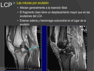 LCP Las roturas por avulsión
 Afectan generalmente a la inserción tibial
 El fragmento óseo tiene un desplazamiento mayor que en las
avulsiones del LCA
 Extenso edema y hemorragia subcondral en el lugar de la
avulsión.
 