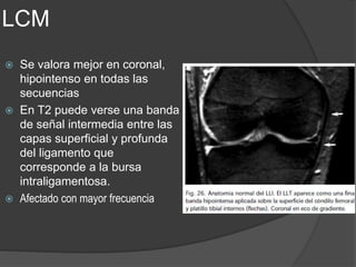 LCM
 Se valora mejor en coronal,
hipointenso en todas las
secuencias
 En T2 puede verse una banda
de señal intermedia entre las
capas superficial y profunda
del ligamento que
corresponde a la bursa
intraligamentosa.
 Afectado con mayor frecuencia
 