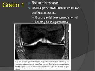 Grado 1  Rotura microscópica
 RM las principales alteraciones son
periligamentosas.
 Grosor y señal de resonancia normal
 Edema y hx periligamentosa
 