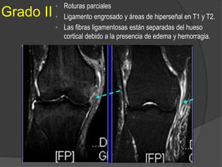 Grado II
• Roturas parciales
• Ligamento engrosado y áreas de hiperseñal en T1 y T2.
• Las fibras ligamentosas están separadas del hueso
cortical debido a la presencia de edema y hemorragia.
 