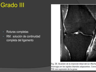 Grado III
• Roturas completas
• RM: solución de continuidad
completa del ligamento
 