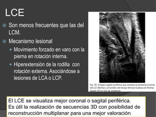 LCE
 Son menos frecuentes que las del
LCM.
 Mecanismo lesional
 Movimiento forzado en varo con la
pierna en rotación interna.
 Hiperextensión de la rodilla con
rotación externa. Asociándose a
lesiones de LCA o LCP.
El LCE se visualiza mejor coronal o sagital periférica.
Es útil la realización de secuencias 3D con posibilidad de
reconstrucción multiplanar para una mejor valoración
 