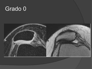 Grado 0
 