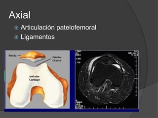 Axial
 Articulación patelofemoral
 Ligamentos
 