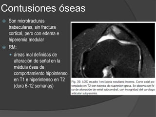 Contusiones óseas
 Son microfracturas
trabeculares, sin fractura
cortical, pero con edema e
hiperemia medular
 RM:
 áreas mal definidas de
alteración de señal en la
médula ósea de
comportamiento hipointenso
en T1 e hiperintenso en T2
(dura 6-12 semanas)
 