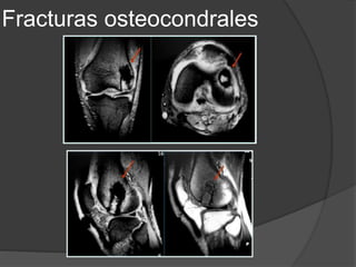 Fracturas osteocondrales
 