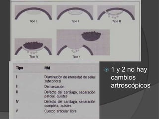  1 y 2 no hay
cambios
artroscópicos
 