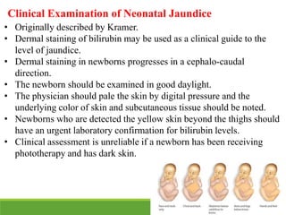 • Originally described by Kramer.
• Dermal staining of bilirubin may be used as a clinical guide to the
level of jaundice.
• Dermal staining in newborns progresses in a cephalo-caudal
direction.
• The newborn should be examined in good daylight.
• The physician should pale the skin by digital pressure and the
underlying color of skin and subcutaneous tissue should be noted.
• Newborns who are detected the yellow skin beyond the thighs should
have an urgent laboratory confirmation for bilirubin levels.
• Clinical assessment is unreliable if a newborn has been receiving
phototherapy and has dark skin.
Clinical Examination of Neonatal Jaundice
 