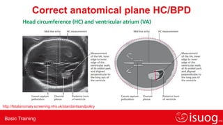 Basic Training
Correct anatomical plane HC/BPD
http://fetalanomaly.screening.nhs.uk/standardsandpolicy
 