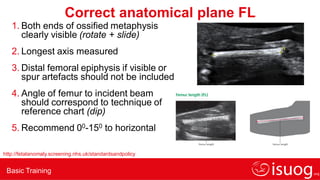 Basic Training
Correct anatomical plane FL
1. Both ends of ossified metaphysis
clearly visible (rotate + slide)
2. Longest axis measured
3. Distal femoral epiphysis if visible or
spur artefacts should not be included
4. Angle of femur to incident beam
should correspond to technique of
reference chart (dip)
5. Recommend 00-150 to horizontal
http://fetalanomaly.screening.nhs.uk/standardsandpolicy
 