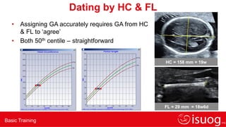 Basic Training
Dating by HC & FL
• Assigning GA accurately requires GA from HC
& FL to ‘agree’
• Both 50th centile – straightforward
HC = 158 mm = 19w
FL = 29 mm = 18w6d
 