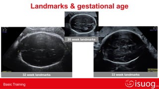 Basic Training
32 week landmarks 33 week landmarks
Landmarks & gestational age
20 week landmarks
 