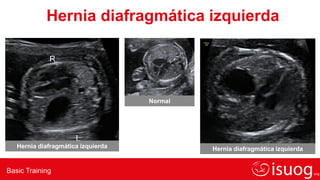 Basic Training
Hernia diafragmática izquierda
R
L
Hernia diafragmática izquierda
Normal
Hernia diafragmática izquierda
 