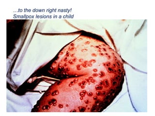 …to the down right nasty!
Smallpox lesions in a child
 