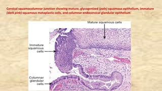 Cervical squamocolumnar junction showing mature, glycogenized (pale) squamous epithelium, immature
(dark pink) squamous metaplastic cells, and columnar endocervical glandular epithelium
 