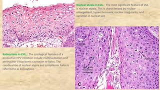 Nuclear atypia in LSIL. : The most significant feature of LSIL
is nuclear atypia. This is characterized by nuclear
enlargement, hyperchromasia, nuclear irregularity, and
variation in nuclear size
Koilocytosis in LSIL. : The cytological features of a
productive HPV infection include multinucleation and
perinuclear cytoplasmic cavitation or halos. The
combination of nuclear atypia and cytoplasmic halos is
referred to as koilocytosis.
 