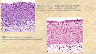 HSIL with marked variability in nuclear size
(anisonucleosis). Anisonucleosis is a variable feature of
HSIL
HSIL: Undifferentiated neoplastic cells replace 50–70% of the
epithelium. The nuclear : cytoplasmic ratio is high, and
the cytoplasmic membranes and the basal layer are indistinct
 