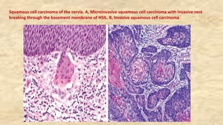 Squamous cell carcinoma of the cervix. A, Microinvasive squamous cell carcinoma with invasive nest
breaking through the basement membrane of HSIL. B, Invasive squamous cell carcinoma
 