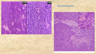 Non keratinizing SCC
 