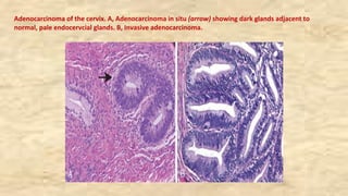 Adenocarcinoma of the cervix. A, Adenocarcinoma in situ (arrow) showing dark glands adjacent to
normal, pale endocervcial glands. B, Invasive adenocarcinoma.
 