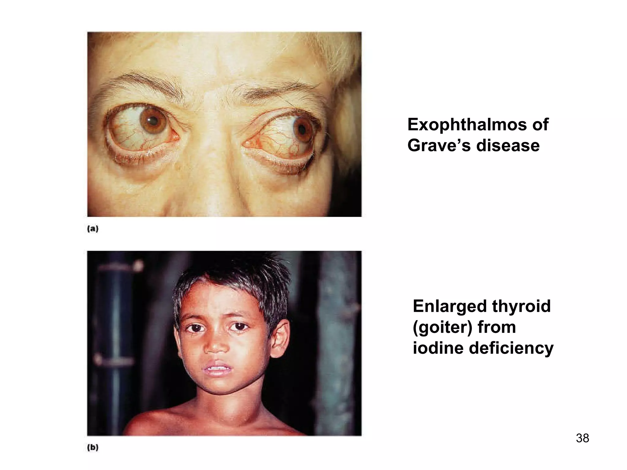 38
Exophthalmos of
Grave’s disease
Enlarged thyroid
(goiter) from
iodine deficiency
 