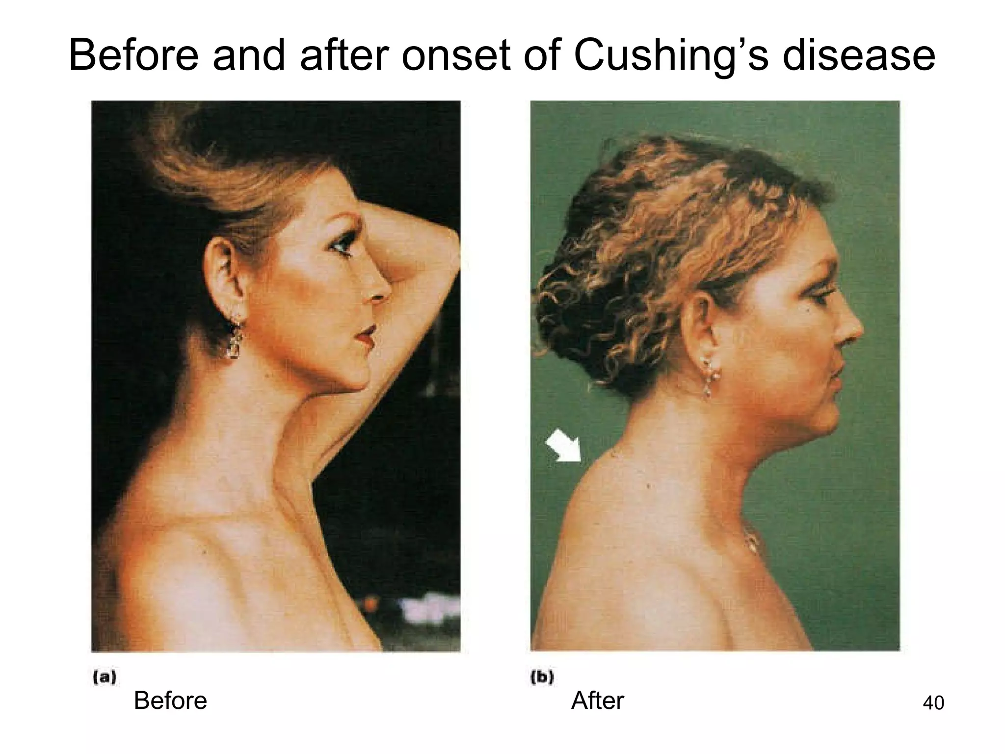 40
Before and after onset of Cushing’s disease
AfterBefore
 