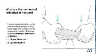 Realigning Method Comprehensive Principles and Methods for Managing Closed Fractures in ...