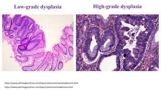 Low-grade dysplasia
https://www.pathologyoutlines.com/topic/colontumortubularadenoma.html
High-grade dysplasia
https://www.pathologyoutlines.com/topic/colontumortvadenoma.html
 