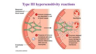 Type III hypersensitivity reactions
 