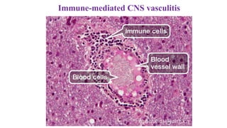 Immune-mediated CNS vasculitis
 