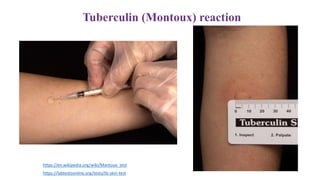https://labtestsonline.org/tests/tb-skin-test
https://en.wikipedia.org/wiki/Mantoux_test
 