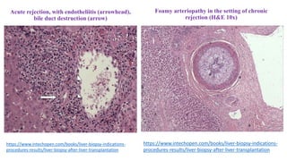 Acute rejection, with endotheliitis (arrowhead),
bile duct destruction (arrow)
https://www.intechopen.com/books/liver-biopsy-indications-
procedures-results/liver-biopsy-after-liver-transplantation
Foamy arteriopathy in the setting of chronic
rejection (H&E 10x)
https://www.intechopen.com/books/liver-biopsy-indications-
procedures-results/liver-biopsy-after-liver-transplantation
 