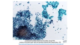 http://www.pathologyoutlines.com/topic/thyroidhashimotosthyroiditis.html?rct=&mobile=off
 
