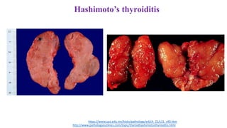 Hashimoto’s thyroiditis
http://www.pathologyoutlines.com/topic/thyroidhashimotosthyroiditis.html
https://www.uaz.edu.mx/histo/pathology/ed/ch_21/c21_s40.htm
 