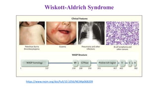 Wiskott-Aldrich Syndrome
https://www.nejm.org/doi/full/10.1056/NEJMp068209
 