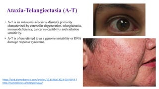 Ataxia-Telangiectasia (A-T)
• A-T is an autosomal recessive disorder primarily
characterized by cerebellar degeneration, telangiectasia,
immunodeficiency, cancer susceptibility and radiation
sensitivity.
• A-T is often referred to as a genome instability or DNA
damage response syndrome.
https://ojrd.biomedcentral.com/articles/10.1186/s13023-016-0543-7
http://numedclinic.ca/telangiectasia/
 