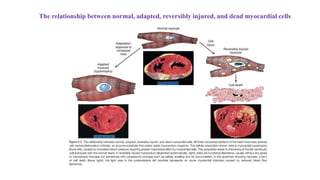 The relationship between normal, adapted, reversibly injured, and dead myocardial cells
 