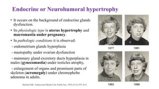 Endocrine or Neurohumoral hypertrophy
• It occurs on the background of endocrine glands
dysfunction.
• Its physiologic type is uterus hypertrophy and
macromastia under pregnancy.
• In pathologic conditions it is observed:
- endometrium glands hyperplasia
- mastopathy under ovarian dysfunction
- mammary gland excretory ducts hyperplasia in
males (gynecomastia) under testicles atrophy,
- enlargement of organs and prominent parts of
skeleton (acromegaly) under chromophobe
adenoma in adults.
Molitch ME. Endocrinol Metab Clin North Am. 1992;21(3):597–614.
 