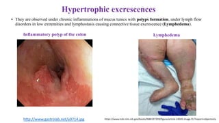 Hypertrophic excrescences
• They are observed under chronic inflammations of mucus tunics with polyps formation, under lymph flow
disorders in low extremities and lymphostasis causing connective tissue excrescence (Lymphedema).
Inflammatory polyp of the colon Lymphedema
http://www.gastrolab.net/y0714.jpg https://www.ncbi.nlm.nih.gov/books/NBK537239/figure/article-24565.image.f1/?report=objectonly
 