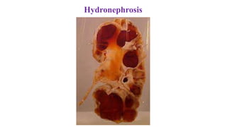 Hydronephrosis
 