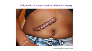 Bulky keloid forming at the site of abdominal surgery
https://en.wikipedia.org/wiki/Keloid
 