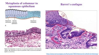 Metaplasia of columnar to
squamous epithelium
https://www.memorangapp.com/flashcards/77897/Pathoma+Ch+10%3A+GI+Pathology/
Barret’s ezofagus
 
