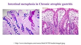 Intestinal metaplasia in Chronic atrophic gastritis
• http://www.intechopen.com/source/html/41705/media/image6.jpeg
 
