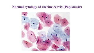 Normal cytology of uterine cervix (Pap smear)
 