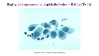 http://nih.techriver.net/patientImages%5C9337.jpg
High-grade squamous intraepithelial lesion – HSIL (CIN II)
 
