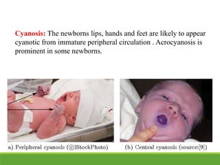 Cyanosis: The newborns lips, hands and feet are likely to appear
cyanotic from immature peripheral circulation . Acrocyanosis is
prominent in some newborns.
 
