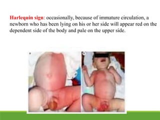 Harlequin sign: occasionally, because of immature circulation, a
newborn who has been lying on his or her side will appear red on the
dependent side of the body and pale on the upper side.
 