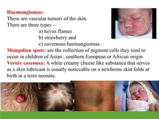 Haemongiomas:
These are vascular tumors of the skin.
There are three types -
a) nevus flames
b) strawberry and
c) cavernous haemangeomas.
Mongolian spots: are the collection of pigment cells they tend to
occur in children of Asian , southern European or African origin
Vernix caseousa: A white creamy cheese like substance that serves
as a skin lubricant is usually noticeable on a newborns skin folds at
birth in a term neonate.
 