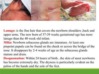 Lanugo: is the fine hair that covers the newborn shoulders ,back and
upper arms. The new born of 37-39 weeks gestational age has more
lanugo than the 40 week old infant.
Milia: Newborn sebaceous glands are immature. At least one
pinpoint papule can be found on the cheek or across the bridge of the
nose. It disappears by 2-4 weeks of age as the sebaceous glands
mature and drain.
Desquamation: Within 24 hours of birth , the skin of most newborns
has become extremely dry. The dryness is particularly evident on the
palms of the hands and the sole of the feet.
 